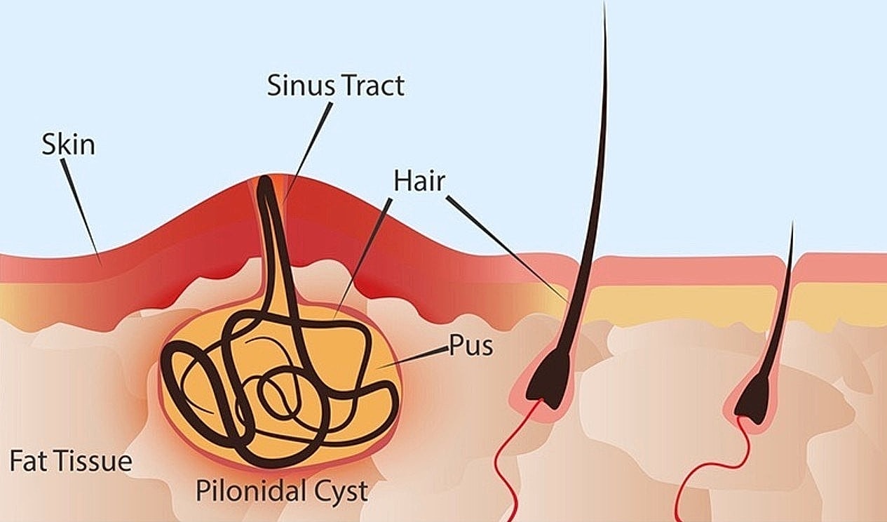 Diagram of pilonidal cyst anatomy and components.
