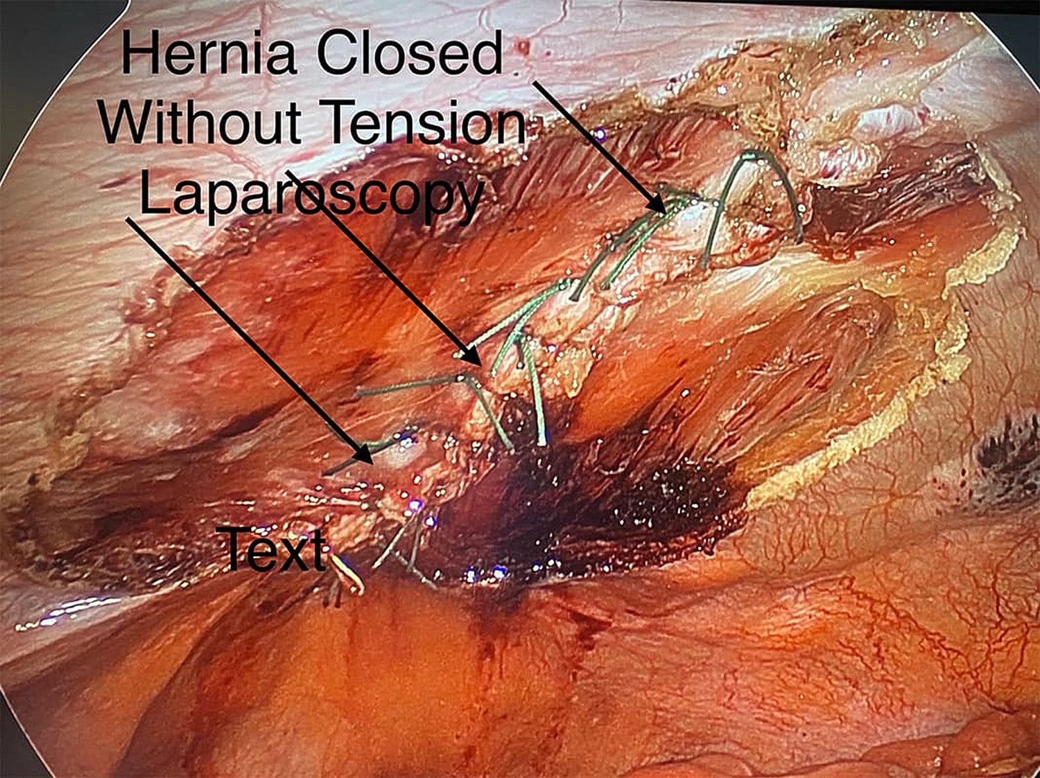 Laparoscopic hernia repair without tension displayed.