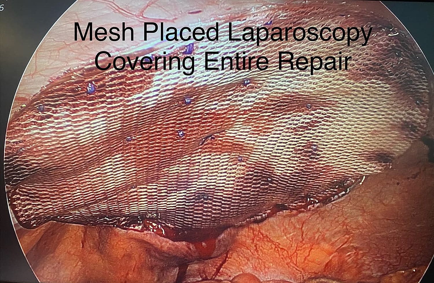 Laparoscopic mesh repair procedure image.