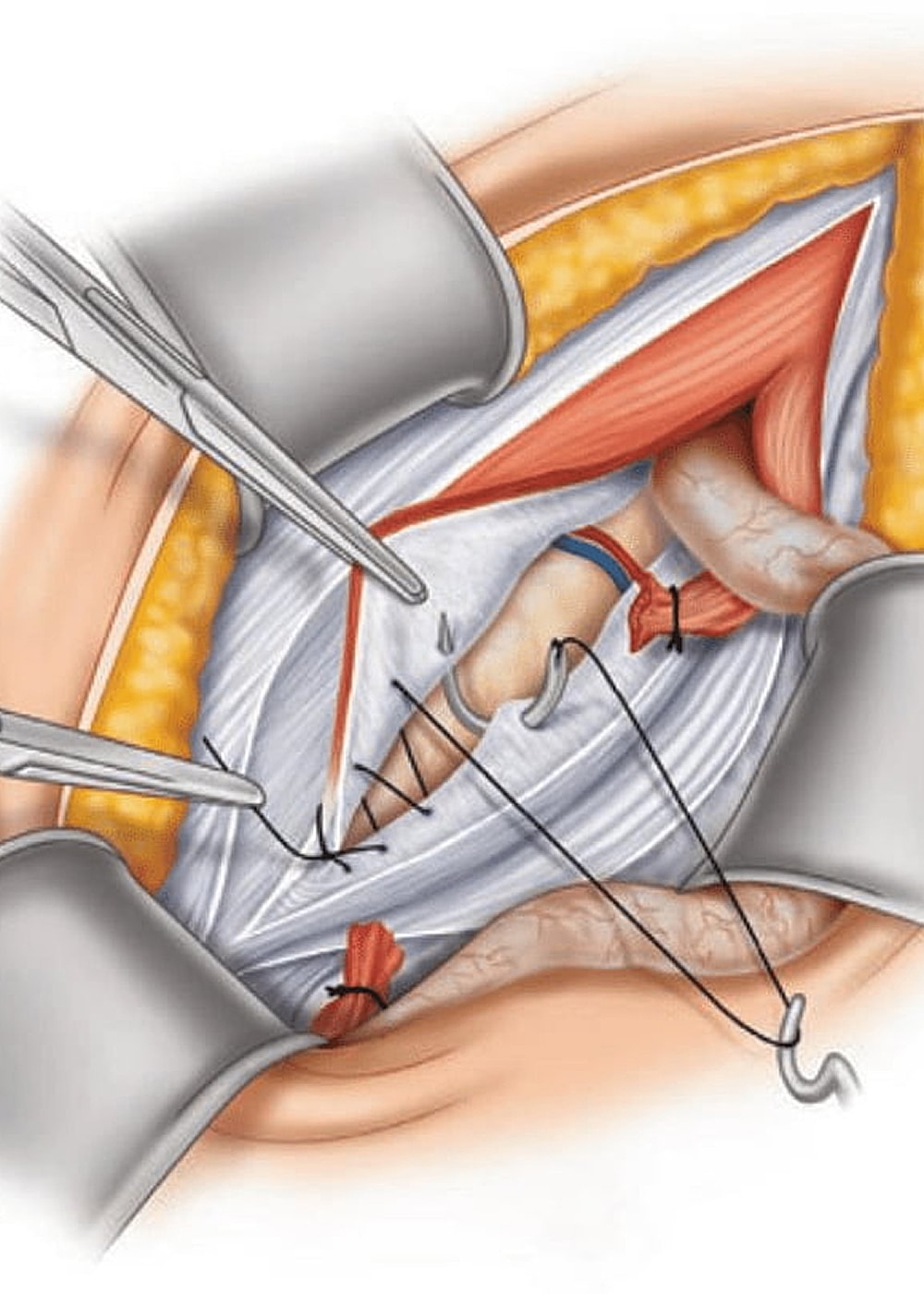 Surgical procedure illustrating suturing techniques.