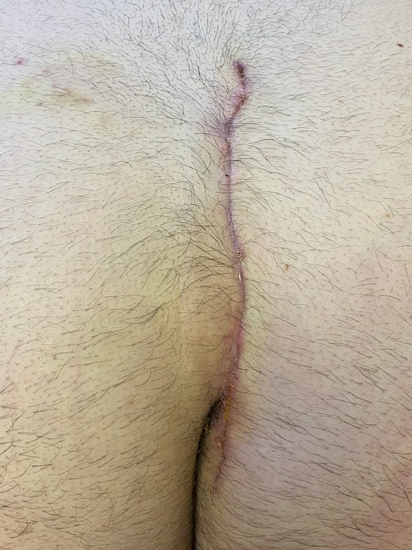 Pilonidal Cyst Treatment Gallery Advanced Minimally Invasive Surgery in Newton Before & After