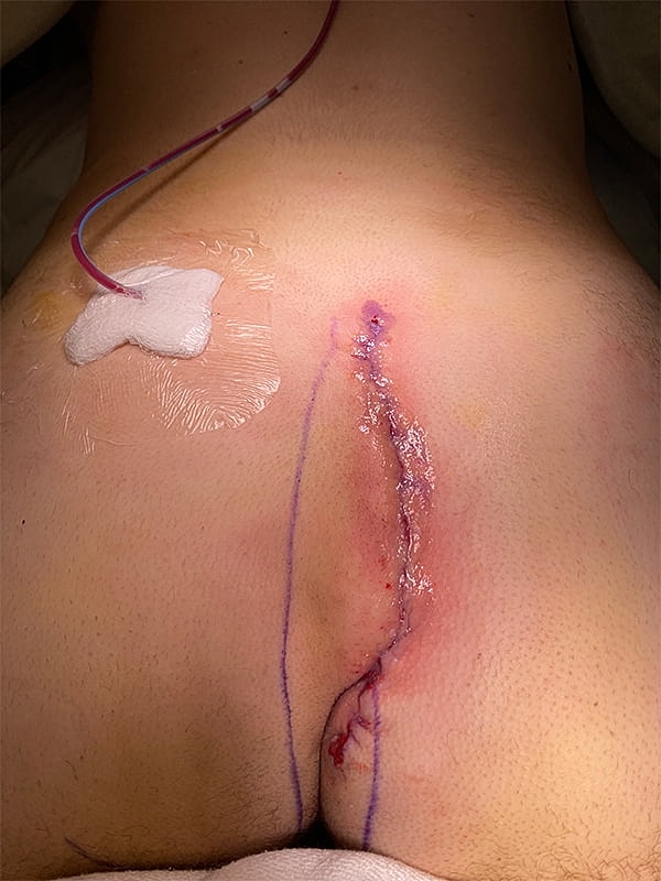 Pilonidal Cyst Treatment Gallery Advanced Minimally Invasive Surgery in Newton Before & After